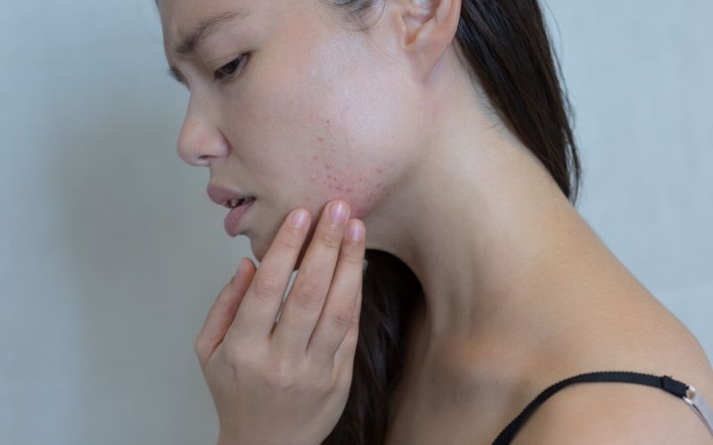 Dunkelhaarige Frau ist im Profil zu sehen, sie schaut bedrückt und fasst mit einer Hand in ihr Gesicht. Im Bereich des Kinns sind Unreinheiten und Rötungen der Haut zu sehen.