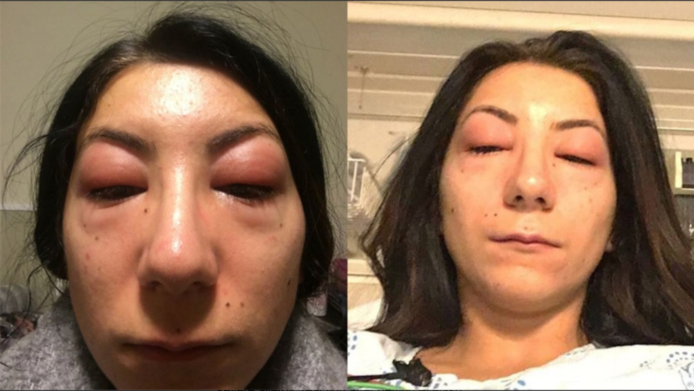 Ottawa woman shares allergic reaction to lashes