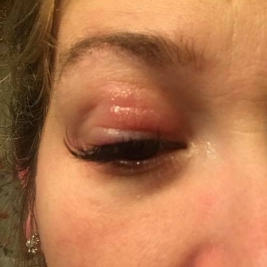 possible inflammation from allergy to lash extensions