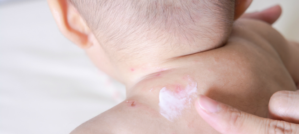 Applying topical solution on mosquito bites